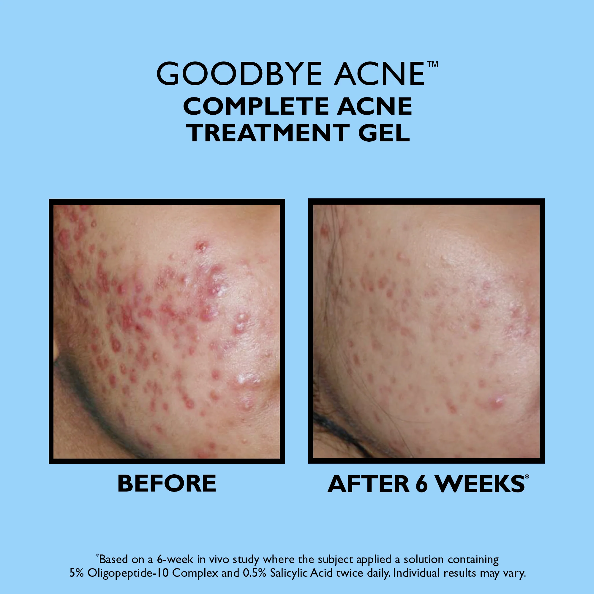 Goodbye Acne Complete Acne Treatment Gel|50 ml / 1.7 fl oz - Image 2